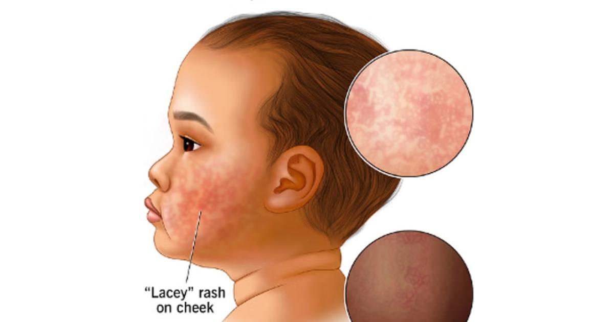 Parents beware: Cases of ‘Sleepy Cheek’ syndrome on the rise in US