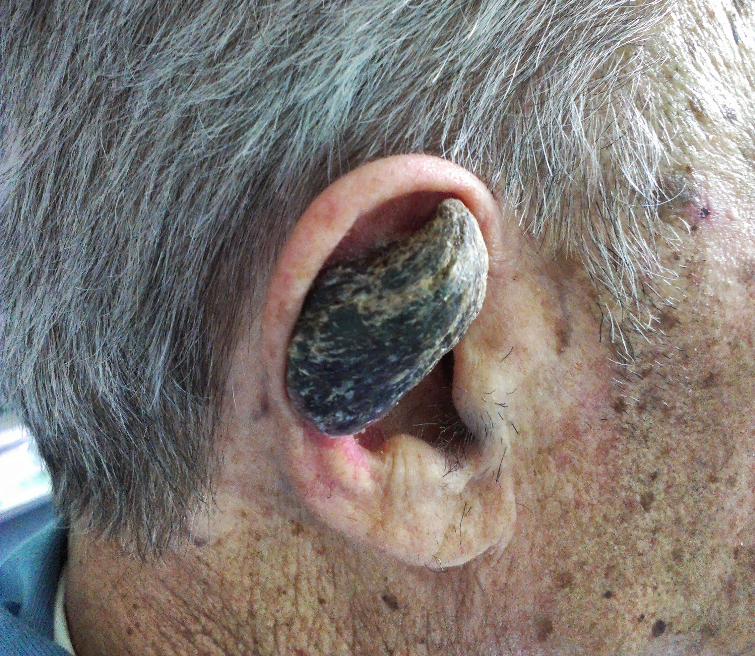 Here’s the reason why some humans grow horns