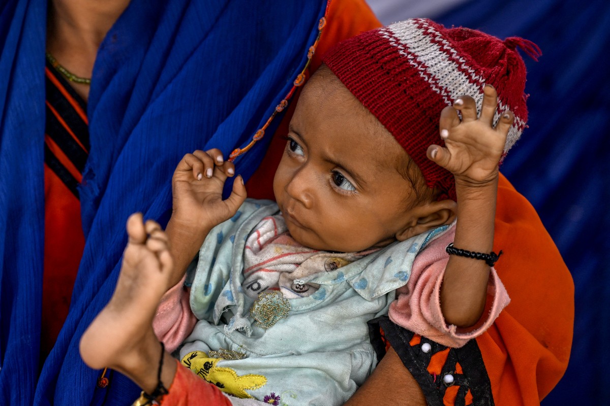Pakistan women Children Malnutrition 